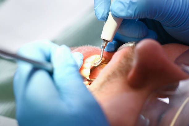 Best Emergency Wisdom Tooth Extraction in Gulf Park Estates, MS